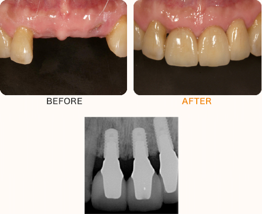 前歯3本のケース