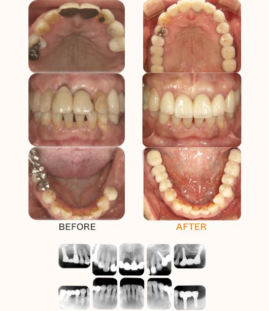 奥歯複数本のケース