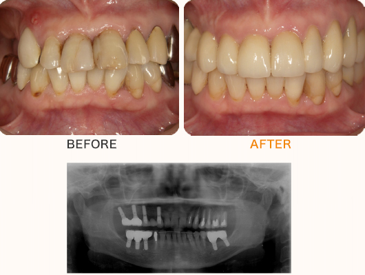 奥歯複数本のケース