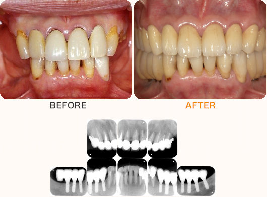 奥歯複数本のケース