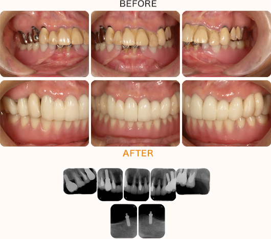 奥歯複数本・下総入れ歯のケース