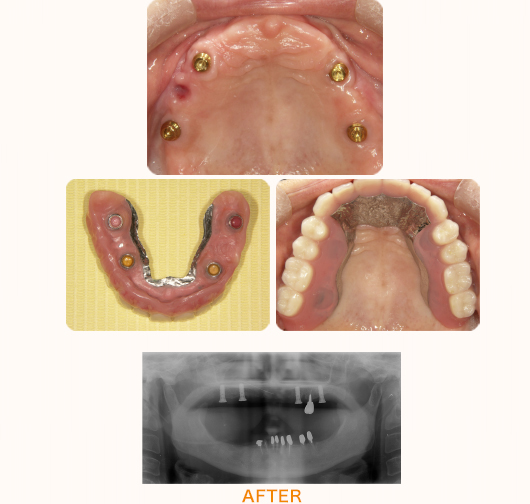 インプラント4本を使用した総入れ歯のケース