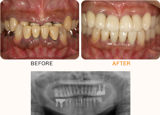 奥歯複数本のケース
