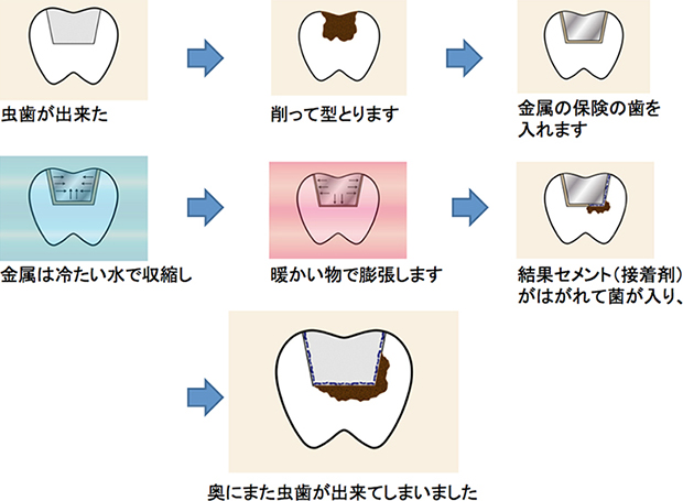 金属歯の場合