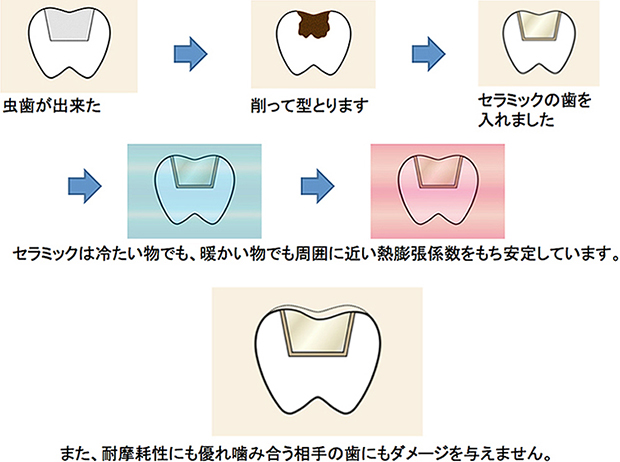 セラミック修復の場合