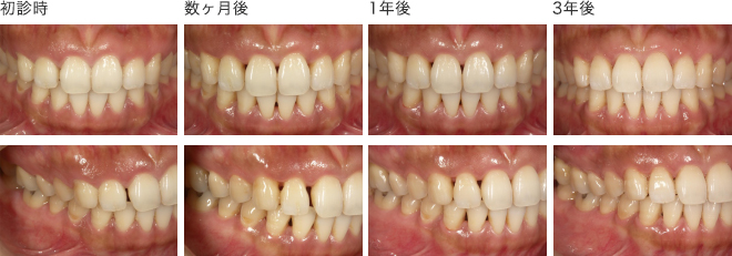 ある患者さんの3年間の歯の治療経過