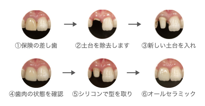 ①保険の差し歯 ②土台を除去します ③新しい土台を入れ ④歯肉の状態を確認 ⑤シリコンで型を取り ⑥オールセラミック