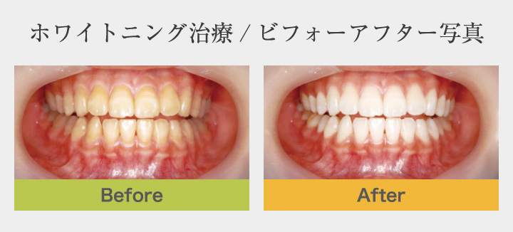 ホワイトニング治療/ビフォーアフター写真
